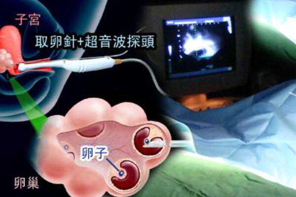 <b>上海助孕费用预算,上海公立三甲医疗机构做三代试管比杭州好吗？</b>